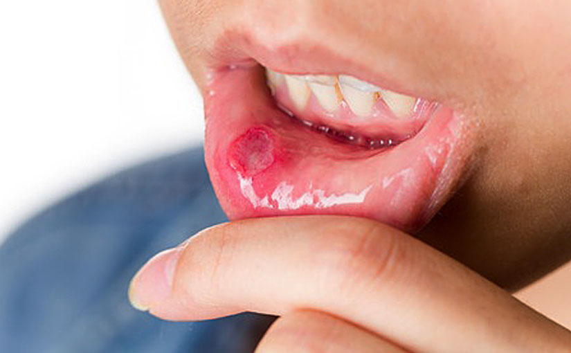 canker sore vs cold sore inside lip
